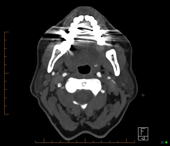 Brachiocephalic trunk stenosis (Radiopaedia 87242-103519 A 75).jpg