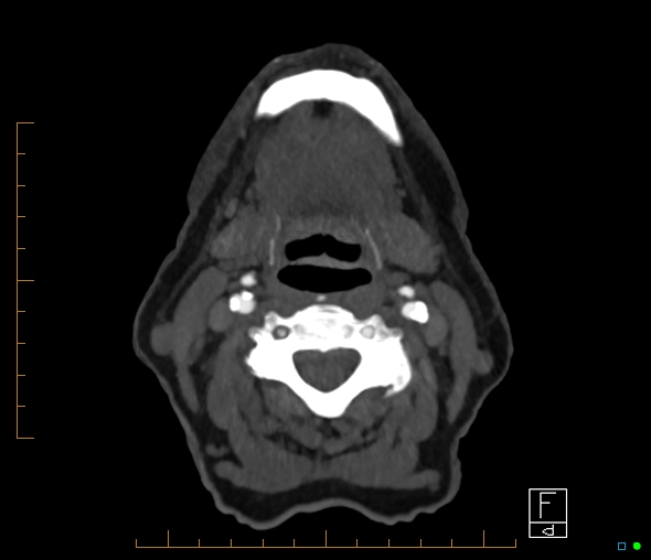 Brachiocephalic trunk stenosis (Radiopaedia 87242-103519 A 92).jpg