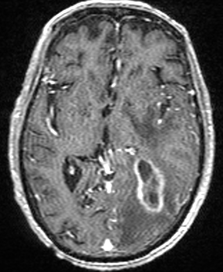 Brain abscess with dual rim sign (Radiopaedia 87566-103938 Axial T1 C+ 83).jpg