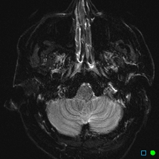 File:Brain death on MRI and CT angiography (Radiopaedia 42560-45689 Axial ADC 7).jpg