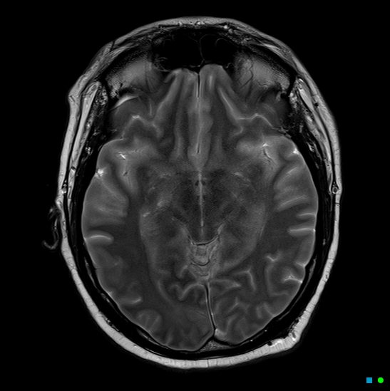 File:Brain death on MRI and CT angiography (Radiopaedia 42560-45689 Axial T2 15).jpg