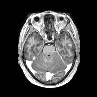 Brain metastases from lung cancer (Radiopaedia 83839-99028 Axial T1 C+ 19).jpg