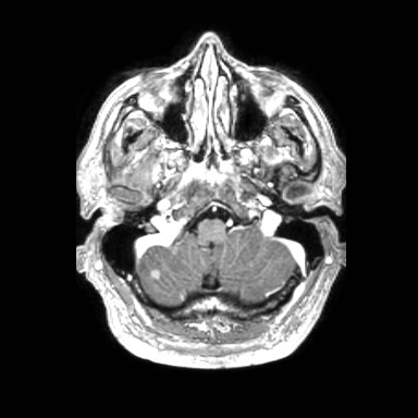 File:Brain metastases from lung cancer (Radiopaedia 83839-99028 Axial T1 C+ 6).jpg