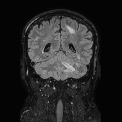 Brain metastases from lung cancer (Radiopaedia 83839-99028 Coronal FLAIR 57).jpg