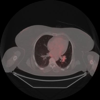 Brain metastasis (Radiopaedia 89847-106962 Axial lung window 35).jpg