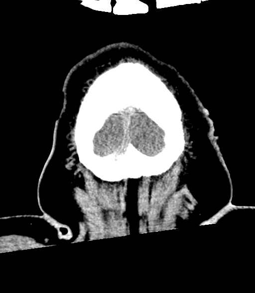 Brainstem hemorrhage (Radiopaedia 81294-94976 Coronal non-contrast 65).jpg