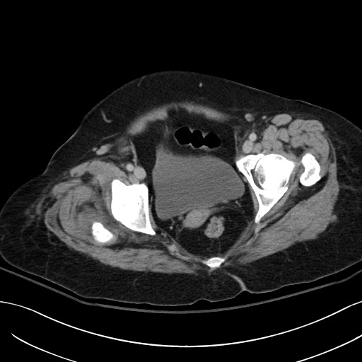Breast carcinoma with pathological hip fracture (Radiopaedia 60314-67974 B 67).jpg