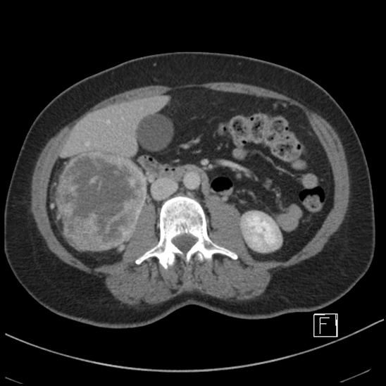 File:Breast metastases from renal cell cancer (Radiopaedia 79220-92225 C 49).jpg