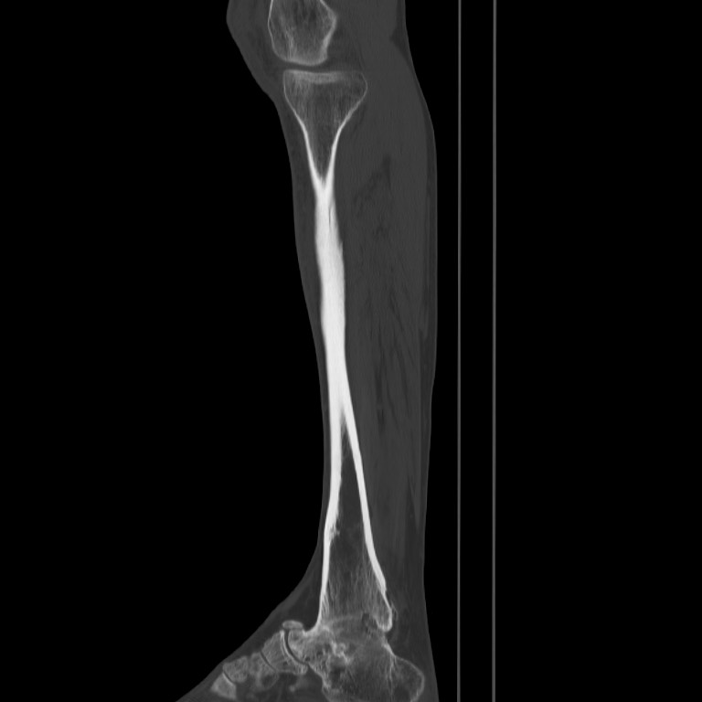 Brodie abscess - tibia (Radiopaedia 66028-75204 Sagittal bone window 20).jpg