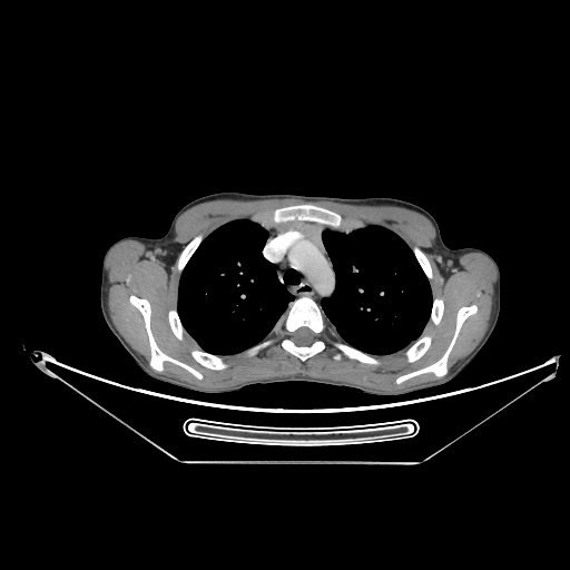 Bronchial carcinoid tumor (Radiopaedia 57187-64090 A 15).jpg