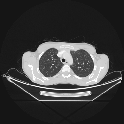 Bronchial carcinoid tumor (Radiopaedia 57187-64090 Axial lung window 16).jpg