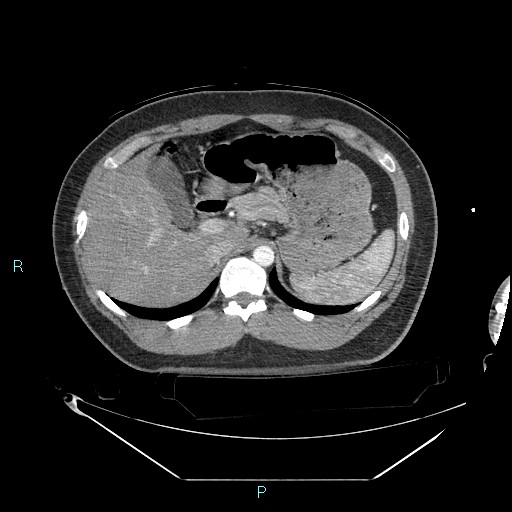 Bronchial carcinoid tumor (Radiopaedia 78272-90870 B 119).jpg