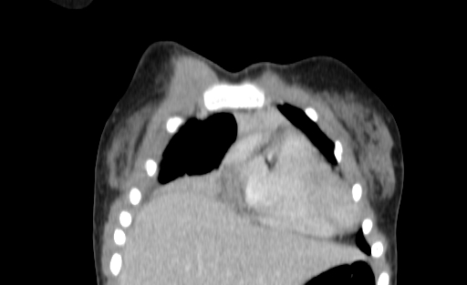 Bronchial mucoepidermoid carcinoma (Radiopaedia 57023-63895 Coronal 12).jpg