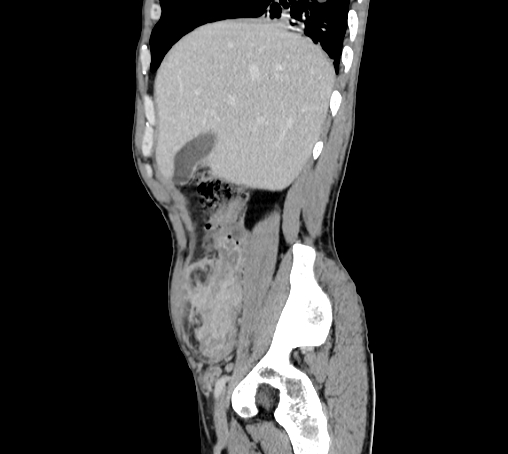 File:Bronchiectasis in Crohn disease (Radiopaedia 60311-67977 D 26).jpg