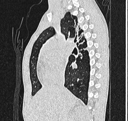 File:Bronchiolitis obliterans (Radiopaedia 71538-81897 Sagittal lung window 26).jpg