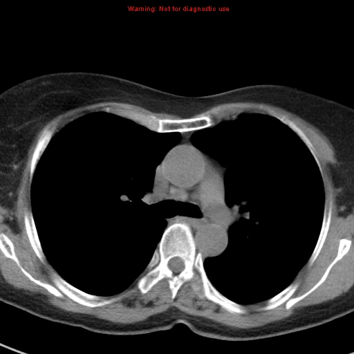 File:Bronchoalveolar carcinoma (BAC) (Radiopaedia 13436-13392 Axial non-contrast 21).jpg