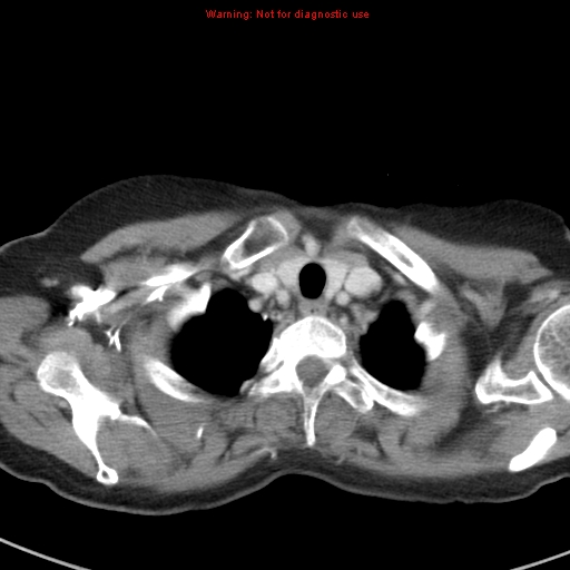 File:Bronchoalveolar carcinoma (BAC) (Radiopaedia 13436-13392 B 5).jpg