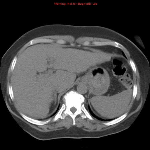 Bronchoalveolar carcinoma (Radiopaedia 13224-13233 Axial non-contrast 40).jpg