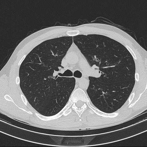 Bronchocele (Radiopaedia 60676-68429 Axial lung window 27).jpg
