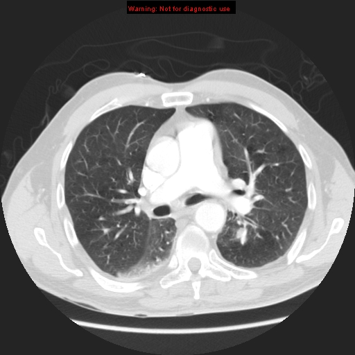 File:Bronchogenic carcinoma brain metastasis (Radiopaedia 9286-105832 Axial lung window 5).jpg