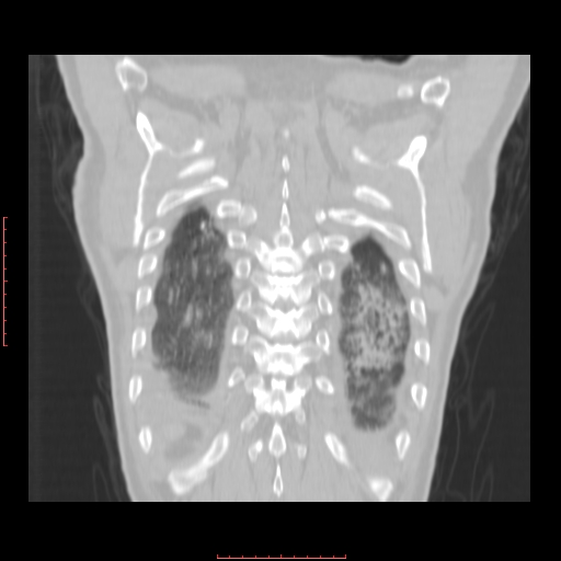 File:Bronchogenic carcinoma with left atrial large deposit - T4N3M1a (Radiopaedia 42316-45428 Coronal lung window 16).jpg