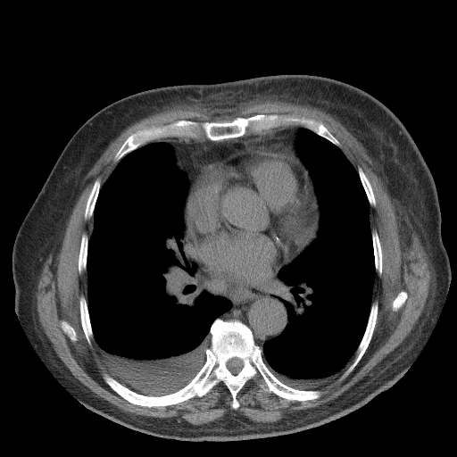 Bronchogenic carcinoma with metastatic lymphadenopathy (Radiopaedia 37671-39569 Axial non-contrast 32).jpg