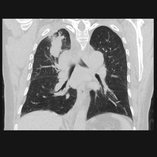 File:Bronchogenic carcinoma with metastatic lymphadenopathy (Radiopaedia 37671-39569 Coronal lung window 29).jpg