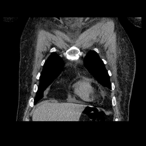 File:Bronchogenic carcinoma with metastatic lymphadenopathy (Radiopaedia 37671-39569 Coronal non-contrast 9).jpg