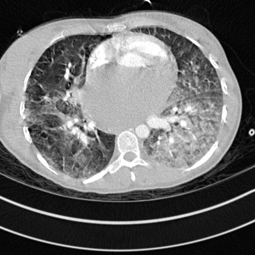 File:Bronchogenic cyst (Radiopaedia 77801-90071 Axial lung window 46).jpg