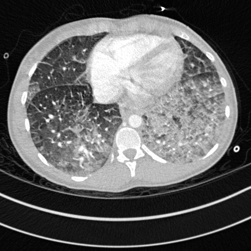 Bronchogenic cyst (Radiopaedia 77801-90071 Axial lung window 62).jpg