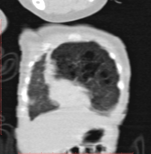 Bronchogenic cyst (Radiopaedia 78599-91409 Coronal lung window 40).jpg