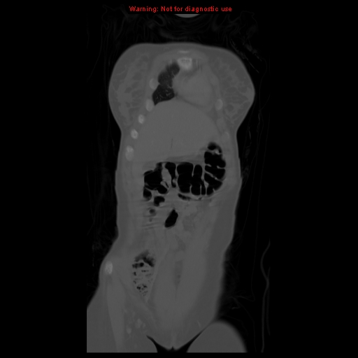 File:Brown tumor (Radiopaedia 12318-12596 D 16).jpg