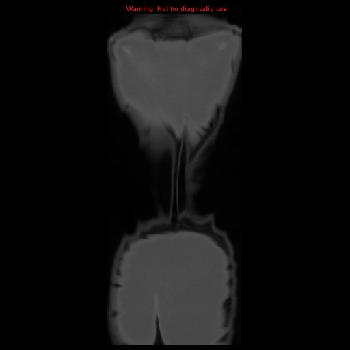 File:Brown tumor (Radiopaedia 12318-12596 D 66).jpg