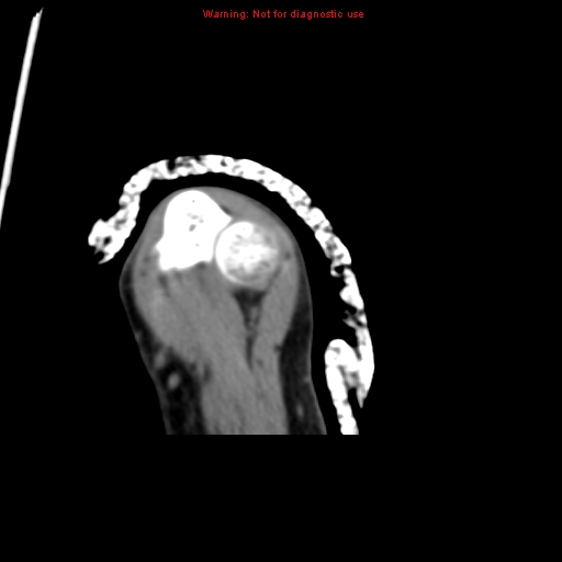 File:Brown tumor (Radiopaedia 12460-12694 Axial non-contrast 129).jpg