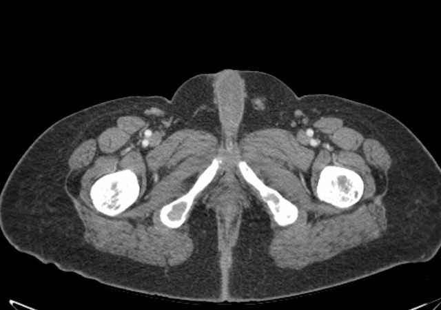Brown tumors compressing the spinal cord (Radiopaedia 68442-77988 E 136).jpg