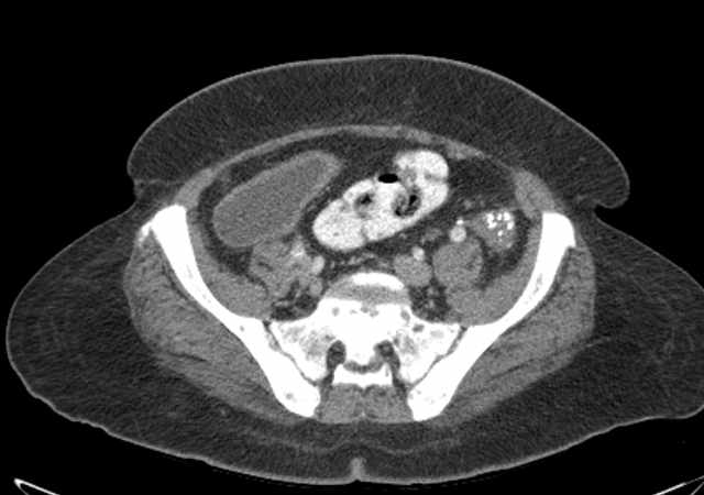 Brown tumors compressing the spinal cord (Radiopaedia 68442-77988 E 94).jpg