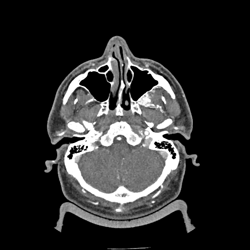 Buccal fat pad arteriovenous malformation (Radiopaedia 70936-81144 D 245).jpg