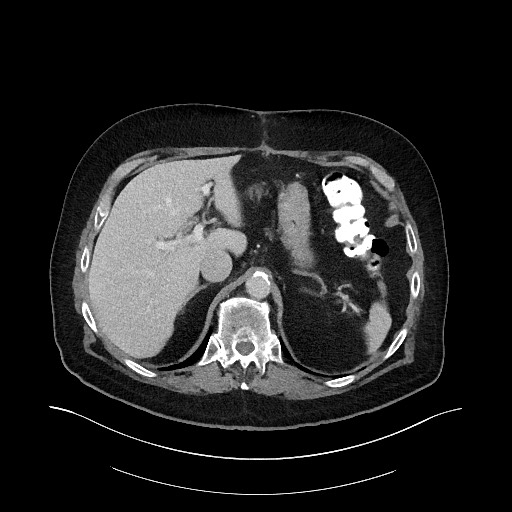 File:Buried bumper syndrome - gastrostomy tube (Radiopaedia 63843-72575 A 11).jpg