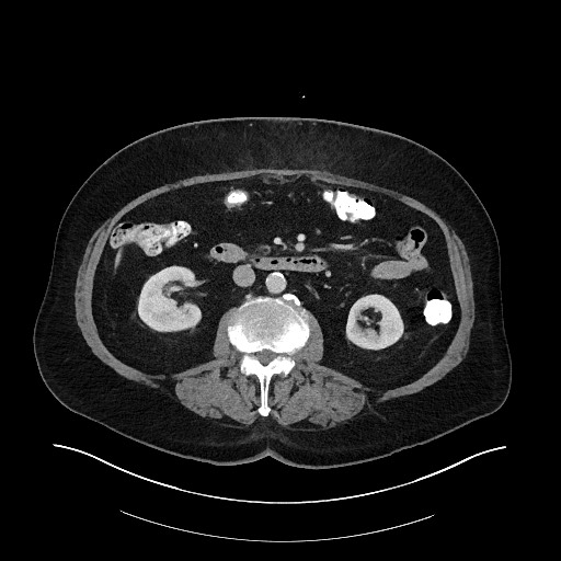 File:Buried bumper syndrome - gastrostomy tube (Radiopaedia 63843-72575 Axial 12).jpg