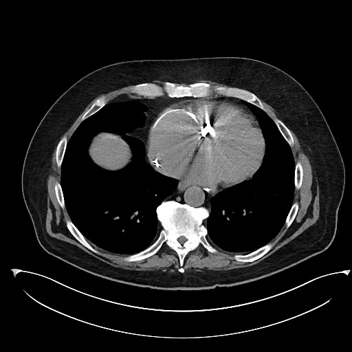 File:Buried bumper syndrome - gastrostomy tube (Radiopaedia 63843-72577 Axial Inject 1).jpg