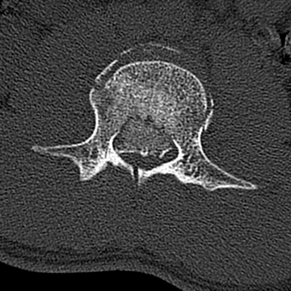 File:Burst fracture (Radiopaedia 53373-59357 Axial bone window 33).jpg