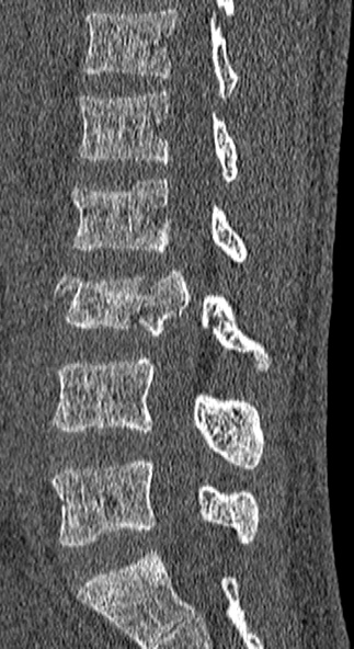 Burst fracture (Radiopaedia 53373-59357 Sagittal bone window 35).jpg