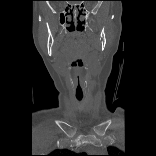 C1 anterior arch (plough) fracture - type 1 (Radiopaedia 76181-87720 Coronal bone window 83).jpg
