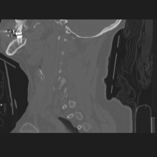 File:C2 fracture (Radiopaedia 34091-35341 Sagittal bone window 21).png