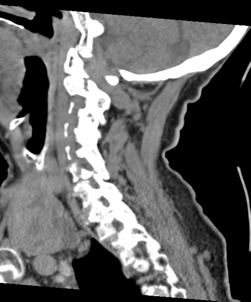 C2 fracture with vertebral artery dissection (Radiopaedia 37378-39199 D 49).png