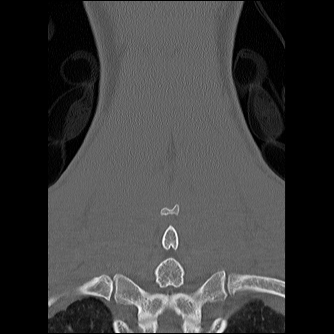 C5 facet fracture (Radiopaedia 58374-65499 Coronal bone window 51).jpg
