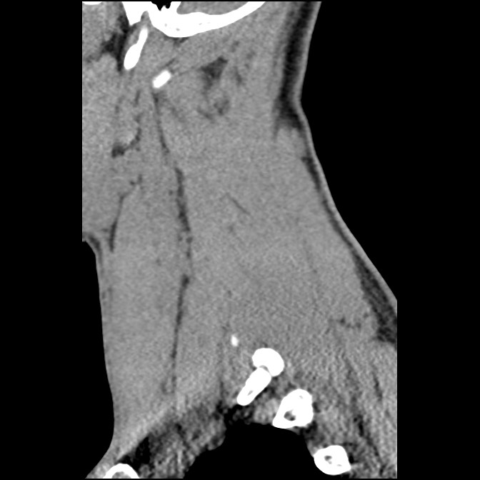 C5 facet fracture (Radiopaedia 58374-65499 D 18).jpg