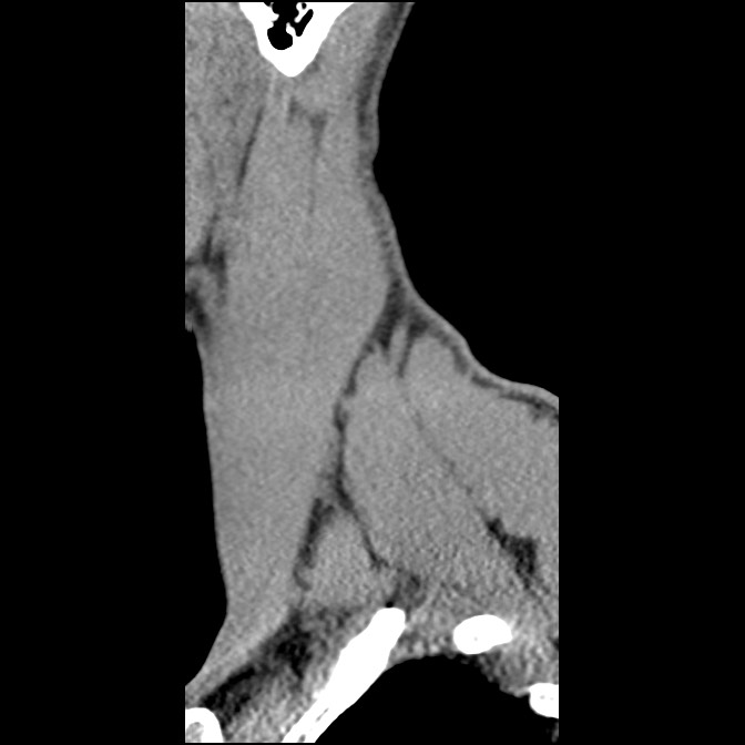 C5 facet fracture (Radiopaedia 58374-65499 D 9).jpg