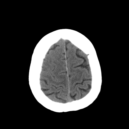 File:CNS lymphoma (Radiopaedia 36983-38639 Axial non-contrast 31).png