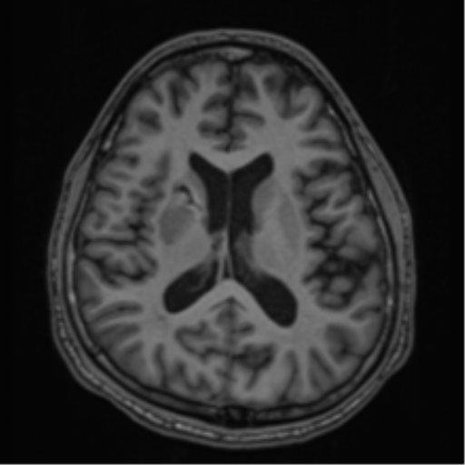 CNS vasculitis (Radiopaedia 55715-62263 Axial T1 41).png
